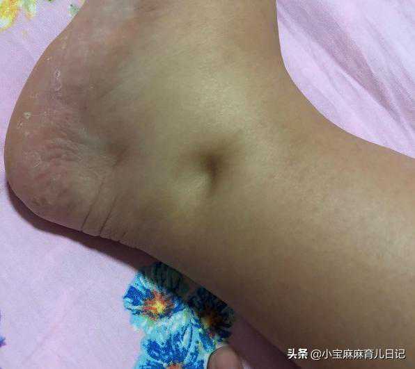 怀孕几个月出现“脚肿”？孕期水肿有2种情况，7招缓解快收藏